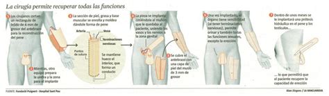 Implante de pene algo incleible. Perfeição: a que custo?: Faloplastia