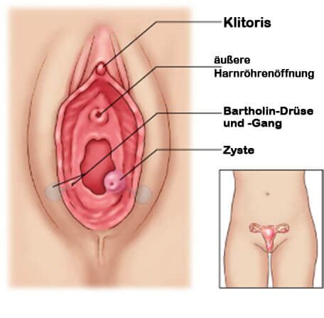 Diese öffnete den abszess mit einer nadel. Bartholinitis: Ursachen und Heilmittel - Besser Gesund Leben