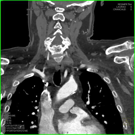 This condition is often diagnosed by angiography and treated by surgery. Left Subclavian Artery Occlusion - Vascular Case Studies ...