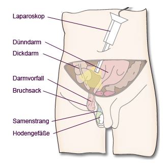 Ich habe auch verwachsungen von meiner blinddarm op, die spüre ich nach 4 jahren manchmal hatte nach der blinddarm op ein jahr später eine schlimme verwachsung, die direkt gelöst wurde. Leistenbruch, Hernie, Leistenhernie, minimalinvasive Operation