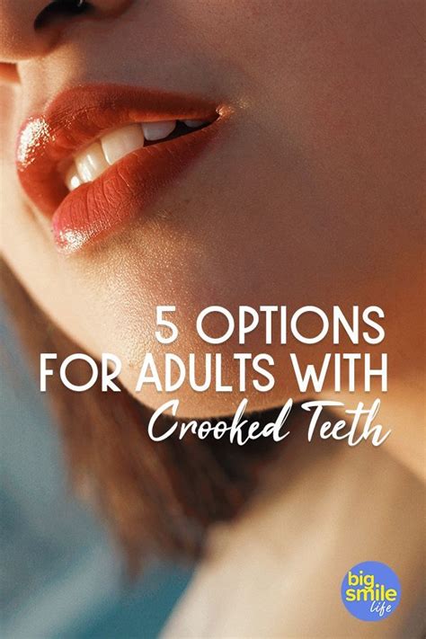 How to fix crooked teeth without braces at home. Options for adults with crooked teeth. It's never too late ...