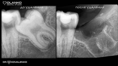 Диета при удаление зубов мудрости Удаление зуба мудрости цена Киев, Бровары - атипичное, сложное, коренного Удаление зуба мудрости цена Киев, Бровары - атипичное, сложное, коренного Диета при удаление зубов мудрости