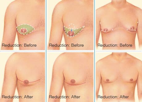 Many people do not realize that men have breast tissue and that they can develop breast cancer. Gynecomastia Male Breast Reduction - Gynecomastia (Male ...