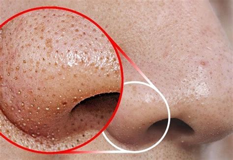 Home » tips kesehatan » kesehatan kulit » 8 cara menghilangkan blackhead dengan putih telur blackhead atau komedo terbuka adalah masalah kulit selain jerawat yang cukup umum namun. Tak Perlu Picit! Blackhead & Whitehead Akan Hilang Dengan ...