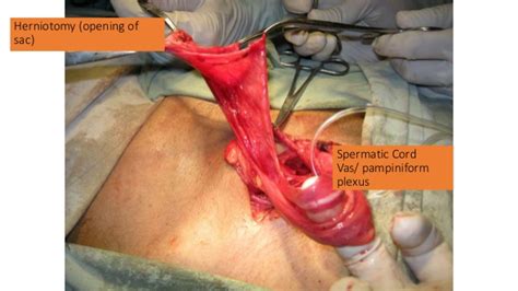 This type of hernia is termed direct as the hernial sac directly protrudes through the inguinal wall, in contrast to indirect ones which arise through the deep ring and enter the inguinal canal. Direct and indirect inguinal hernia final for website