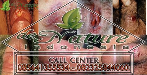 Penting bagi kaskuser untuk tahu apa itu penyakit raja singa atausipilis. Cara Mengobati Sipilis Pada Wanita - Pengobatan Sipilis de ...