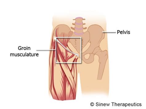 The hip adductor muscles consist of the adductor longus, adductor brevis, adductor magnus, pectineus, and gracilis muscles. Groin Pulled Strained Information - Sinew Therapeutics