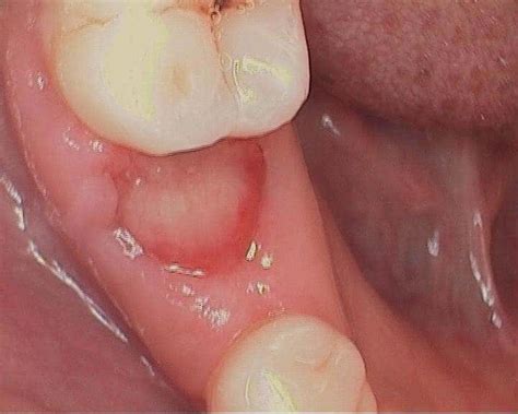 It's rare to experience problems from a wisdom tooth extraction much later on. How long is Recovery Period after Wisdom tooth Removal? | NDA
