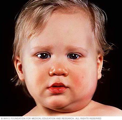 It usually happens in childhood. Mumps Disease Reference Guide - Drugs.com