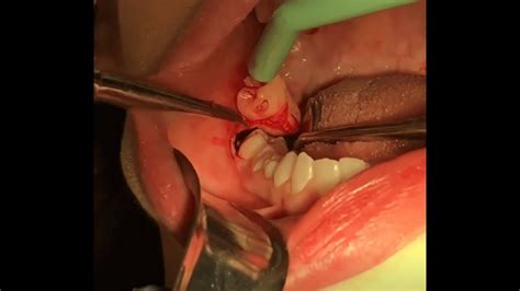 We cover the best tips and tricks to make sure you get a restful night of sleep post surgery. 4 Wisdom Teeth Removal Surgery - YouTube