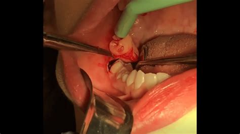 If you break your fast and choose to eat within the given window, your appointment will be rescheduled. 4 Wisdom Teeth Removal Surgery - YouTube