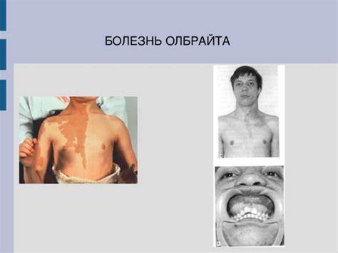 Диет при заболевании сахарным диабетом