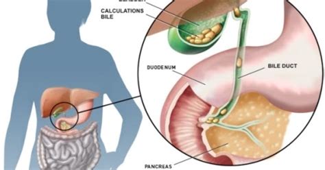 Bladder, pancaqers, the bladder, gall stones, gallbladder, gall bladder. Rasa Senak, Mual dan Muntah Tanda Awal Batu Karang Hempedu