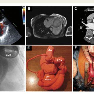 Anomalous pulmonary venous drainage into the cs. (A) Transthoracic echocardiogram short axis at the mitral ...