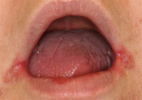 Yeast infection on lips and in the mouth can cause sores of. Swollen Lip Causes, Why Is My Lip Swollen - Allergies ...
