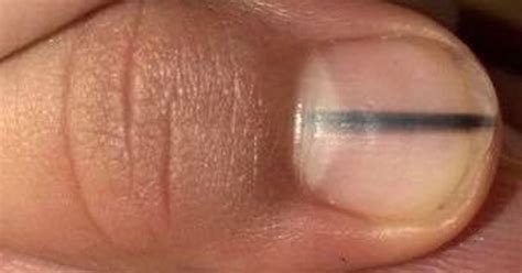 Une bande noire sur l'ongle: symptôme inattendu du cancer de la peau ...