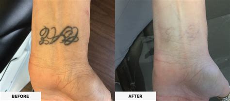 The number of treatments needed to remove a tattoo depends on the type of tattoo, the patient's skin color, and colors used in the tattoo. Laser Tattoo Removal - Las Vegas, Henderson, St George ...