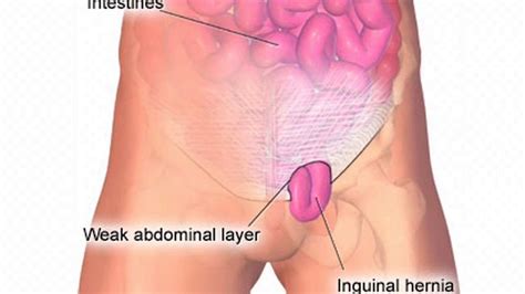 4.7k views reviewed >2 years ago Hernias After Weight Loss Surgery: Are You at Risk ...