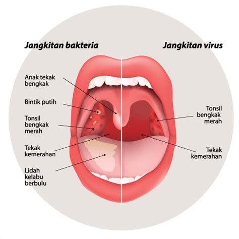 Penyebab tekak dan telinga yang gatal yang paling biasa adalah alahan, virus, dan jangkitan. Menangani Sakit Tekak Anak Anda - Positive Parenting