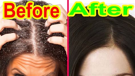 You can also heat the oil for hot oil treatment. Hair fall solution for men and women | update - To Get Rid ...