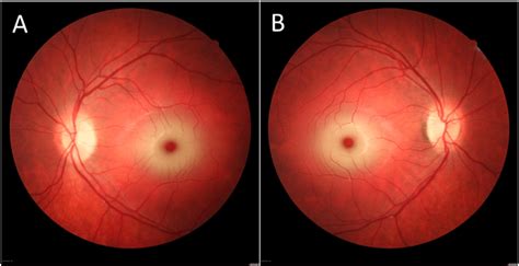They range from the size of a pinpoint up to ¼ of an inch in diameter. Patient's fundoscopy revealed bilateral (A: left; B: right ...