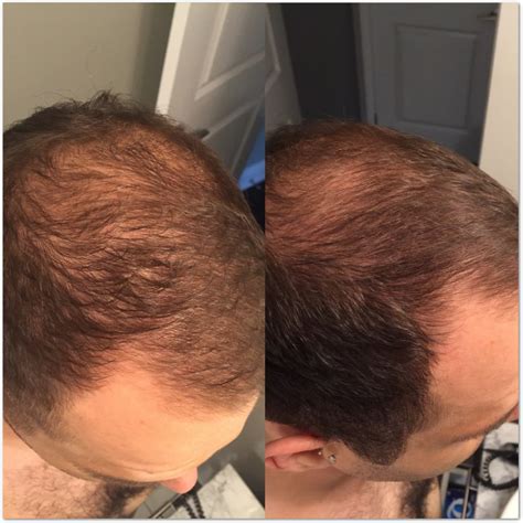 A study was conducted where 500 persons including both men and women (between the age of 18 and 55) participated in the study. Revita Shampoo Review - Care Your Hair