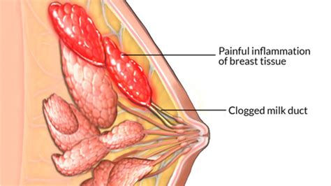 At the same time, daily cases have fallen. Saluran ASI Tersumbat dan Mastitis - The Urban Mama