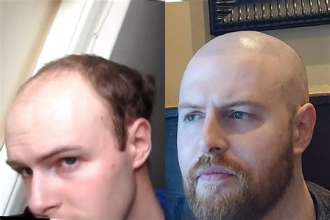Scalp Micropigmentation doesn't work for blonde / red ...