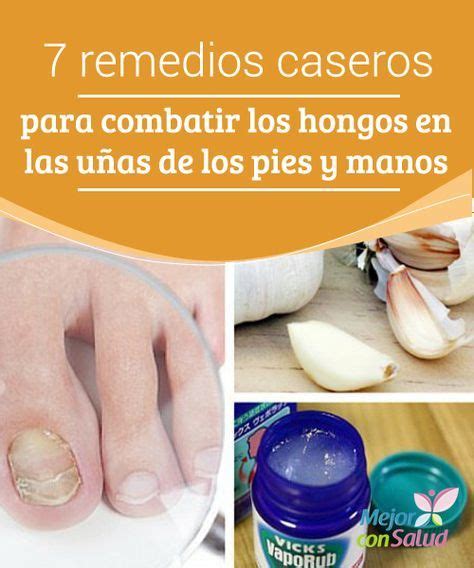 Los hongos en las uñas también se denominan «onicomicosis». 7 Remedios caseros para eliminar los hongos de las uñas de ...