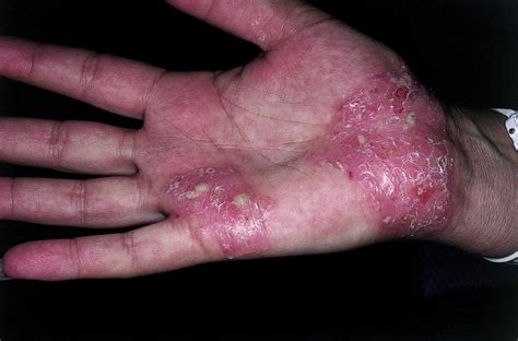 Psoriasis tends to run in families, but it may be skip generations. Palmaplanter pustular psoriasis natural treatment and pictures