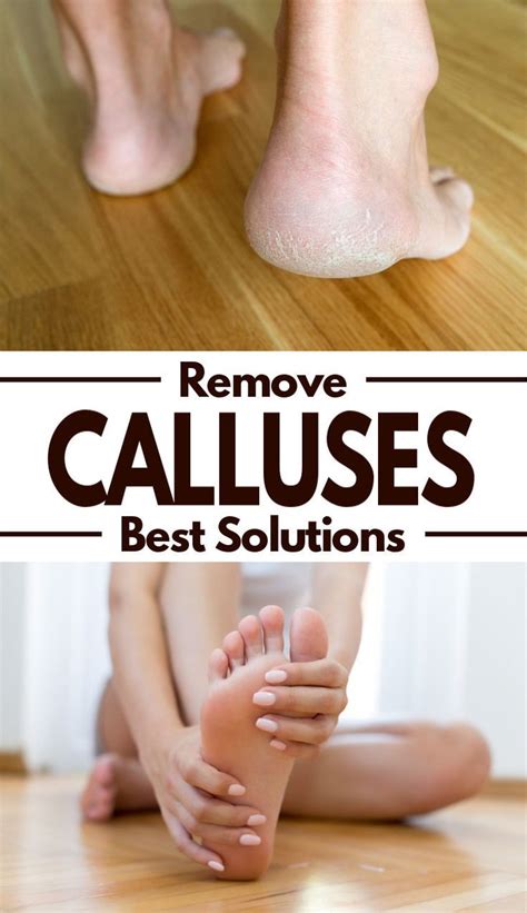 How to prevent foot calluses from forming? The Best Ways to Get Rid of Calluses | Fluster Buster ...