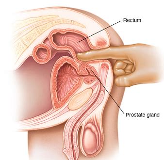 Note the significant base extension posterior to the bladder. What Is a Prostate Exam? | New Health Advisor