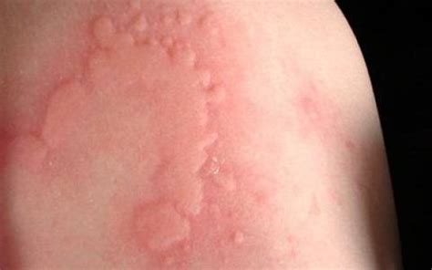 You have dry and itchy skin. Skin Allergies Remedy Fast Relief from Itchiness and ...