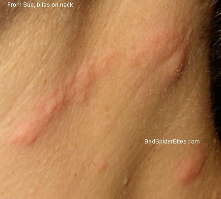 Any area of exposed skin is vulnerable to attacks from these insects. Bedbugs Bites: Discussion Pg 9