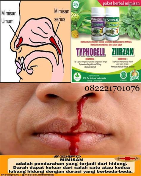 Ternyata daerah itu sangat harum, kelihatan kalau adikku ini sangat menjaga kebersihan tubuhnya. Nama obat hidung keluar darah/mimisan di apotik umum | by ...