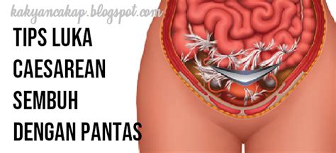 Saya mempunyai kelahiran normal selepas 3 minggu dengan jahitan luar saya menggunakan benang yang boleh digunakan sebagai daging.setelah terdapat benang benang yang digunakan yang tidak dislodged. Tips Luka Caesarean Sembuh Dengan Pantas. (Berkesan ...