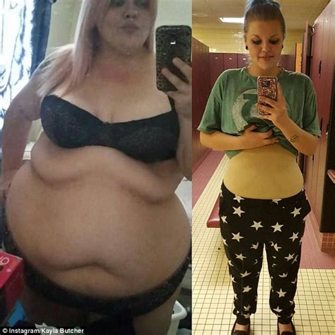 Excess skin removal gets rid of the extra skin weight loss sometimes leaves behind. Woman who lost 186lbs left with 'apron' of excess skin | Daily Mail Online