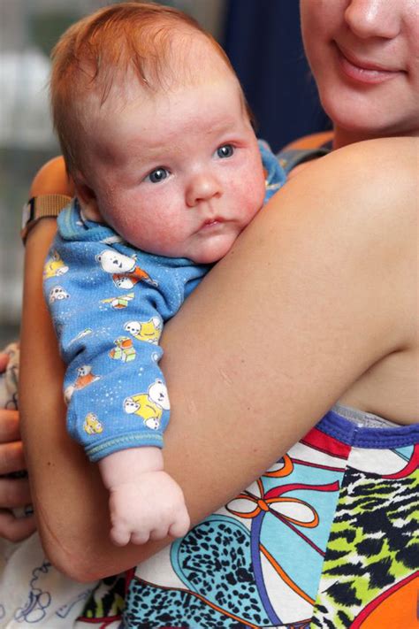 Milk allergy and dairy intolerance in babies, infants and. Introducing Dairy To Milk Allergy Infant / Common Baby ...