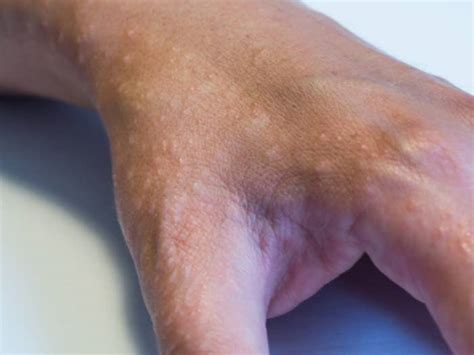 Contact dermatitis can occur due to contact with any soap, chemical, cosmetic, cloth or to any allergen to which a person is allergic. Ja, Sonnenallergien gibt es wirklich und hier erfährst du ...