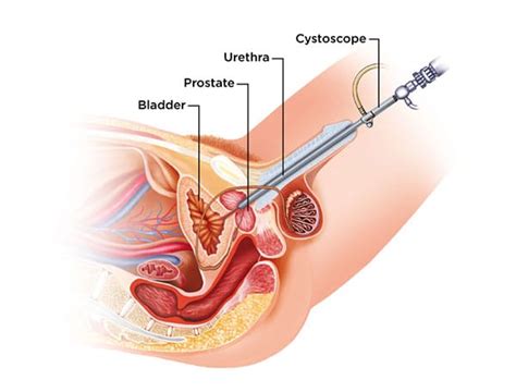 The notion that refined sugar causes cancer or that cutting sugar from the diet is a good way to treat cancer are two common — and incorrect — claims that turn up in a google search. Bladder Cancer, Accurate Detection | Cxbladder