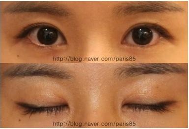 The upper eyelid surgery is less traumatic because it is usually performed under light sedation anaesthesia or under local anaesthesia and the patient may leave the clinic already a couple of hours after the procedure. Teuim Aesthetic Plastic Surgical Clinic Dr.Kwon: double ...