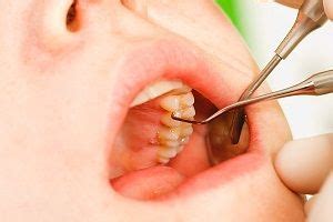 How to fix a loose tooth at home? How to Tighten Loose Teeth Naturally: Top Home Remedies ...