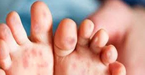 Saraf kaki dan tangan apakah saling berkaitan? Cegah Jangkitan Penyakit Tangan, Kaki Dan Mulut (HFMD ...