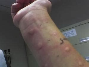 In severe cases you may see swelling, redness, and larger blisters. Mold allergies found in foods | General center ...