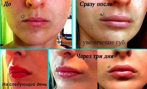 После диеты отек