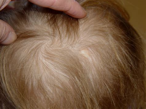Leukemia cutis clinical presentation 3. Medical Pictures Info - Aplasia Cutis Congenita