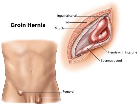 Lump in groin area female cancer. Ogden Inguinal Hernia Repair, Treatment & Surgery | Dr ...