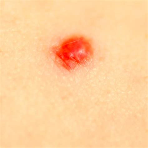Thankfully, these tumors are benign because they do not affect the. How to Get Rid of Cold Sores Naturally - Dr. Axe