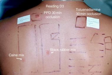 It is a known allergen to humans, affecting some 1 in 250,000 people on average. PPD) allergic patient with cross-reactivity to caine mix and black... | Download Scientific Diagram