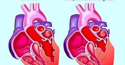 La miocardite è un'infiammazione del muscolo cardiaco solitamente correlata a infezioni virali, batteriche o fungine (o micotiche). Medicina Tradizionale Cinese: Insufficienza cardiaca ...